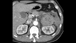 Pheochromocytoma bleeding  Life Threatening condition  Beware [upl. by Oringas]