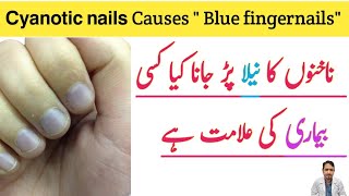 BluishPurple Discoloration Of Nails  Cyanotic Nails  ناخن کا رنگ نیلا پڑنے کی وجہ اور علاج [upl. by Dnalro]