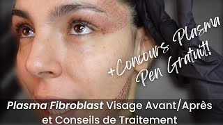 Plasma Fibroblast Visage AvantAprès  Giveaway  Je Vous dis Tout [upl. by Eilssel]