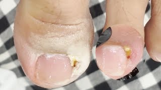 Treatment for Ingrown Toenails 001 satisfying nails [upl. by Pinelli]