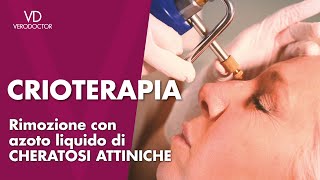 Crioterapia rimozione con azoto liquido di cheratosi attiniche [upl. by Friedman37]