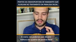 Craniopuntura de Yamamoto na paralisia facial [upl. by Erika]