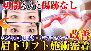 【整形】瞼のたるみ・目の見開き・おでこのシワを一気に改善！バレない切開手術眉下リフトの施術密着 [upl. by Bryna]