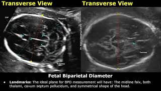 How To Measure Fetal Biparietal Diameter On Ultrasound  BPD Measurements  Biometric Parameters USG [upl. by Wheaton]