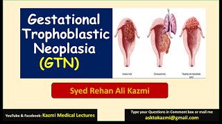 Part 2  GTD  Invasive mole vs choriocarcinoma Obstetric review  KML [upl. by Akihsal]