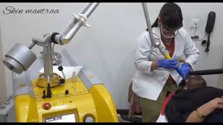 SKIN LIGHTENING WHITENING AND BRIGHTENING LASER TREATMENT [upl. by Gwennie432]