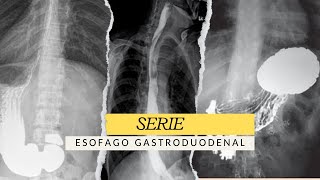 SERIE ESÓFAGO GASTRODUODENAL ESTUDIO RADIOLÓGICO radiologia radiology [upl. by Saxena]