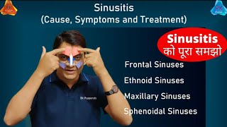 Sinusitis on Sinuses  Types and Treatment By Dr Puspendra [upl. by Morez]