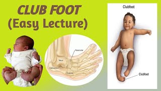 CLUB FOOTTALIPES EQUINOVARUSEpidemiology etiology risk factors classification and Management [upl. by Retniw]