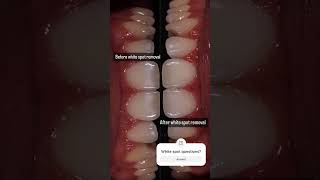 Resin infiltration for a noninvasive white spot treatment of these teeth cosmeticdentist [upl. by Gaudette]