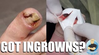 EXTREMELY DEEP AND INFECTED INGROWN TOENAILS 100 CRINGE WORTHY [upl. by Florina]