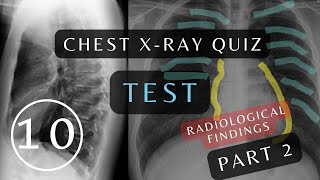 Can You Pass This Quiz Questions and Answers Part 2  10 Essential Chest Xrays xray respiratory [upl. by Marela]