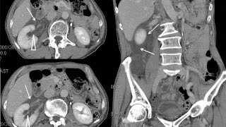 Moderate obstructive uropathy region due to renal calculus  cect abdomen and pelvis [upl. by Wilmette]