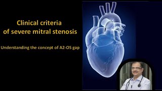 Clinical Criteria of Severe Mitral Stenosis Understanding A2 Opening Snap Gap amp Murmur Length [upl. by Grunenwald856]