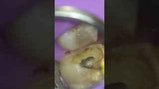 Molar Root Canal  Finding MB2 [upl. by Aydiv]