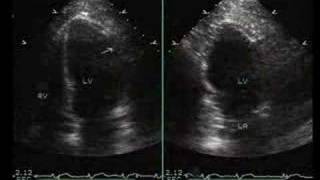 InferiorPosterior and Lateral Myocardial Infarction [upl. by Cresida92]