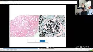 TMAThrombotic Microangiopathy in Renal Allograft Dr Pallav Gupta Lec 7 [upl. by Hgielram]