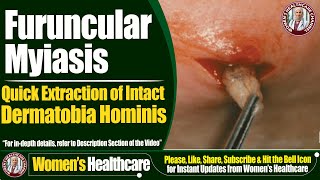 Furuncular Myiasis  Quick Extraction of Intact Dermatobia Hominis  Womens Healthcare [upl. by Durante638]