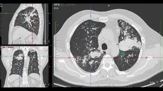 Aspergilosis Broncopulmonar Alergica ABPA por tomografia TC [upl. by Neruat]