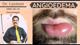 What Is Angioedema  Angioedema  Causes N Treatment  Allergy  Dermatology [upl. by Ttevi]