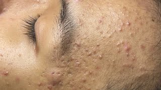 ACNE TREATMENT VU QUYNH MI Acne On Teens Cheek 2024 [upl. by Ettinger375]