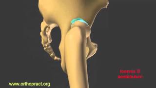 hip dysplasia luxation pseudo acetabulum [upl. by Larret487]