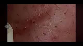 Milia Cysts Removal Blackheads On Face At HomeEp75 [upl. by Leo514]