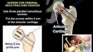 Hip Fractures  Everything You Need To Know  Dr Nabil Ebraheim [upl. by Femi]