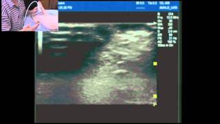 Ultrasound guided ankle block part 2 Supdeep peronealfibular nerves and saphenous nerve [upl. by Violante]