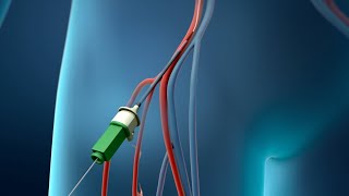 Coronary Angioplasty Femoral Access [upl. by Asemaj]