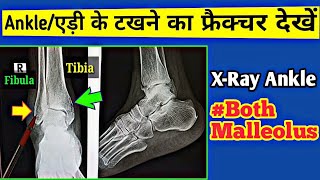 Fracture Both Malleolus XRay  एड़ी के टखने का फ्रैक्चर देखें  XRay Ankle joint  Uday XRay [upl. by Eiramanel]