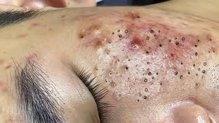 Treatment Of Blackheads And Hidden Acne 057 [upl. by Columbus]