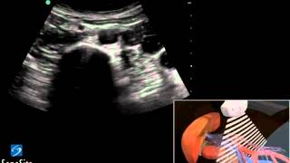 Guide 3D Ecografia Aorta Addominale  Ecografia SonoSite [upl. by Avik]