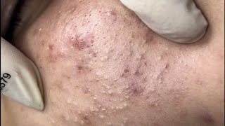 ACNE TREATMENT VU QUYNH MI  Blackheads Removal  Cystic Removal On Chin 2023 [upl. by Iztim]