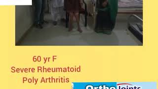 TKR in Polyarthritis Rheumatoid [upl. by Kaitlin]