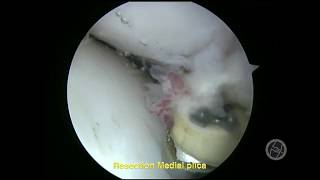 MEDIAL PLICA MY ARTHROSCOPIC TREATMENT Part 1 [upl. by Aihgn192]