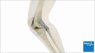 How knee arthroscopy is carried out  Bupa Health [upl. by Annavaj]