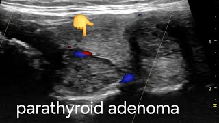 Large Parathyroid adenoma ultrasound and color Doppler video [upl. by Euqinwahs]