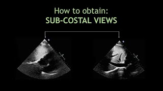 How to obtain SUBCOSTAL VIEWS Echocardiography [upl. by Nylecaj]