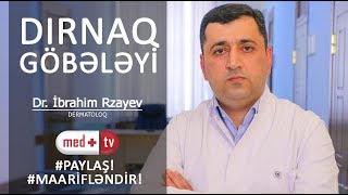 Dirnaq gobeleyi xesteliyi  Dırnaq göbələyi  Dermatoloq İbrahim Rzayev  MEDPLUS I3 [upl. by Eelanna]