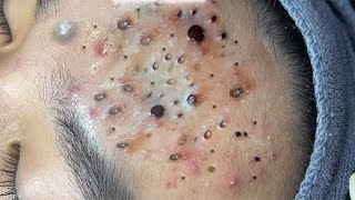 Big Cystic Acne Blackheads Extraction Blackheads amp Milia Whiteheads Removal Pimple Popping  6817 [upl. by Manley]