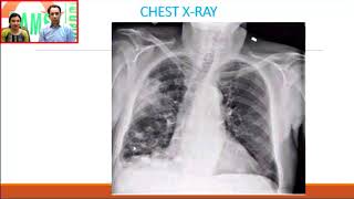 DAMS Medicine Unplugged Nocardia CXR [upl. by Aynas251]