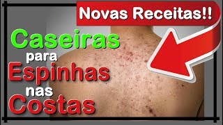 🔴 ESPINHAS NAS COSTAS  COMO ACABAR COM ESPINHAS NAS COSTAS EM 24 HORAS OU MENOS RECEITA CASEIRA [upl. by Kirshbaum]