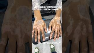 VITILIGO SKIN DISEASE PERMANENT TREATMENT  WHITE SPOTS TREATMENT  LUEKODERMA CURE vitiligocures [upl. by Akinirt]