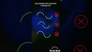 goldmann applnation tonometry [upl. by Ziladnerb]