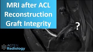 Knee MRI After ACL Reconstruction Surgery [upl. by Ettenig]