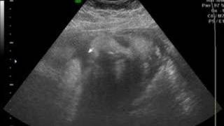 36 week Ultrasound [upl. by Notsirb]