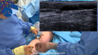 TRLOP closure of perforator veins in varicose vein surgery using NTD [upl. by Ailana53]