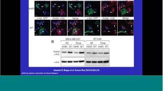 Identifying a Novel Diagnostic and Therapeutic Target for Metastatic Breast Cancer [upl. by Ydieh]