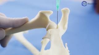 Enso Hip joint injection video [upl. by Idnis680]